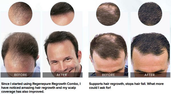 regenepure hair loss shampoo